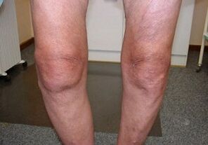 How to treat your knee wrist arthrosis