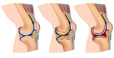 Phases of the development of the knee joint arthrosis